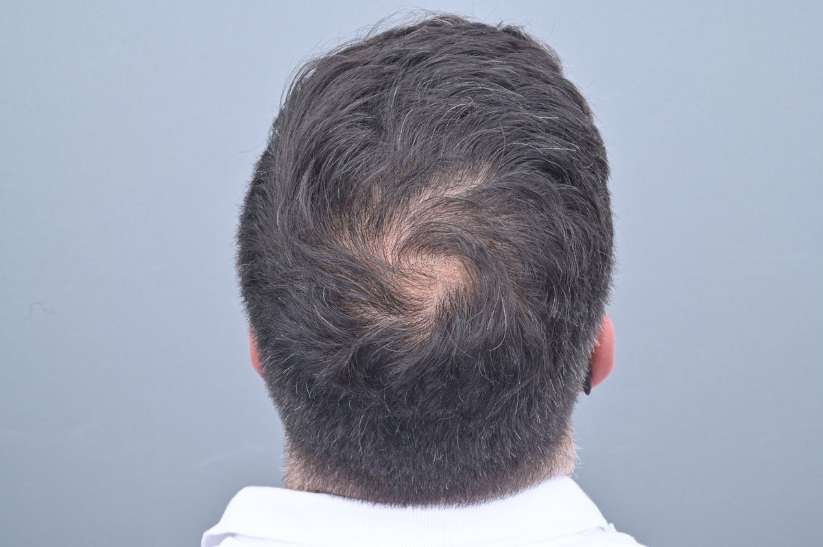 Cuir chevelu au jour 0, avant la cure