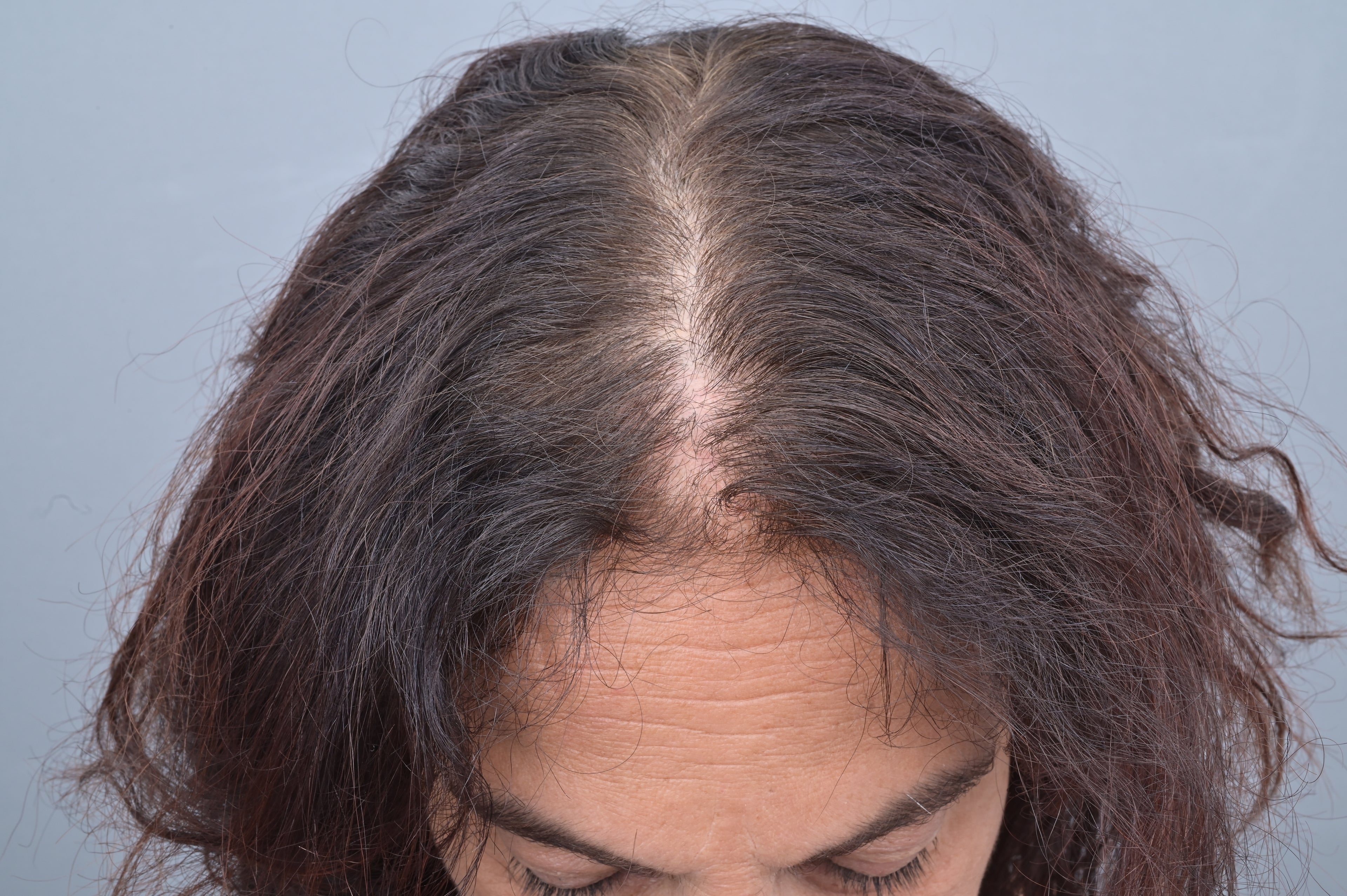 Photo d'une femme prise de haut, avec une raie de cheveux dégarnie. Elle souffre d'alopécie 