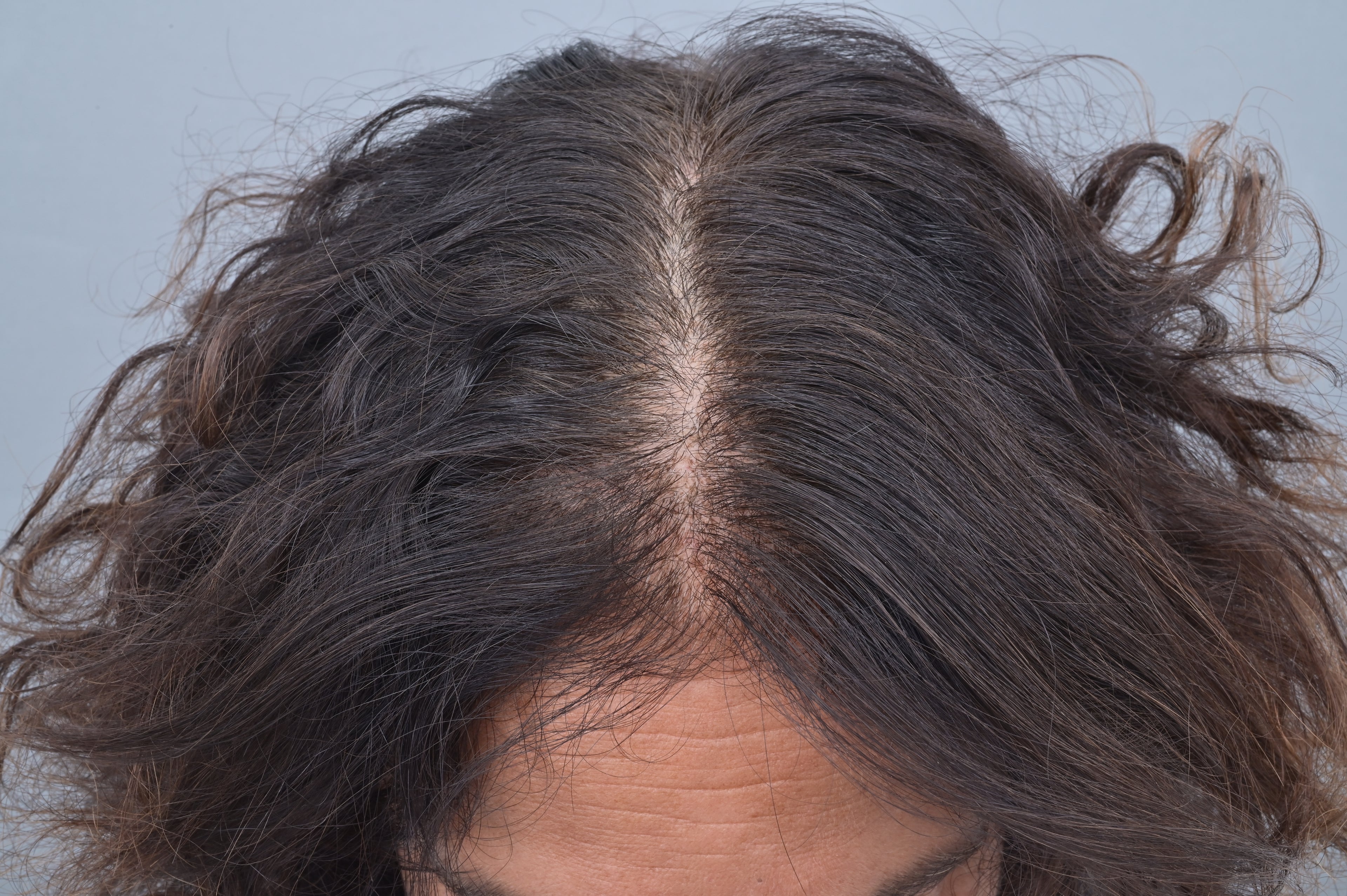 photo d'une tête prise de haut après 3 mois de cure La Résistante. Il y a beaucoup plus de cheveux que sur la photo avant.