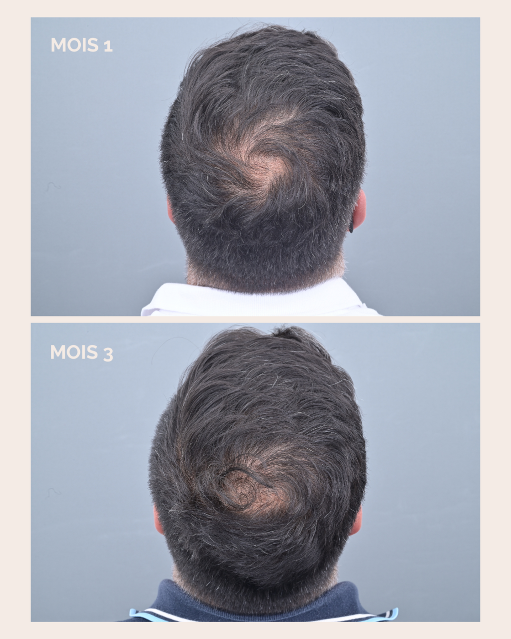 Comparatif des cheveux avant et après 3 mois de cure La Résistante