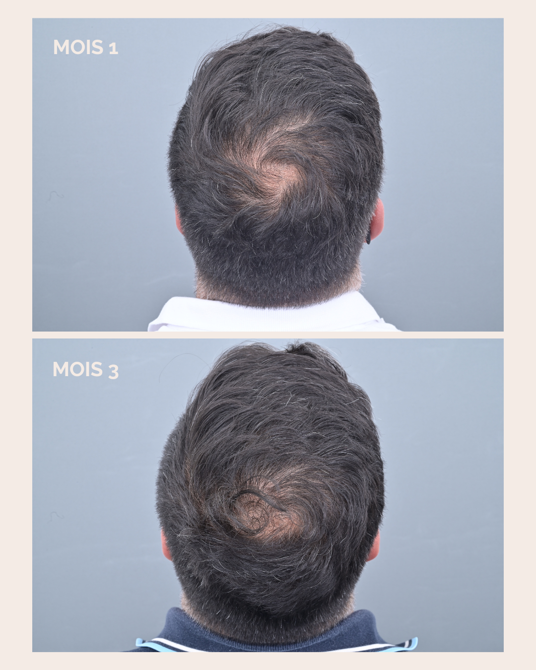 Comparatif des cheveux avant et après 3 mois de cure La Résistante