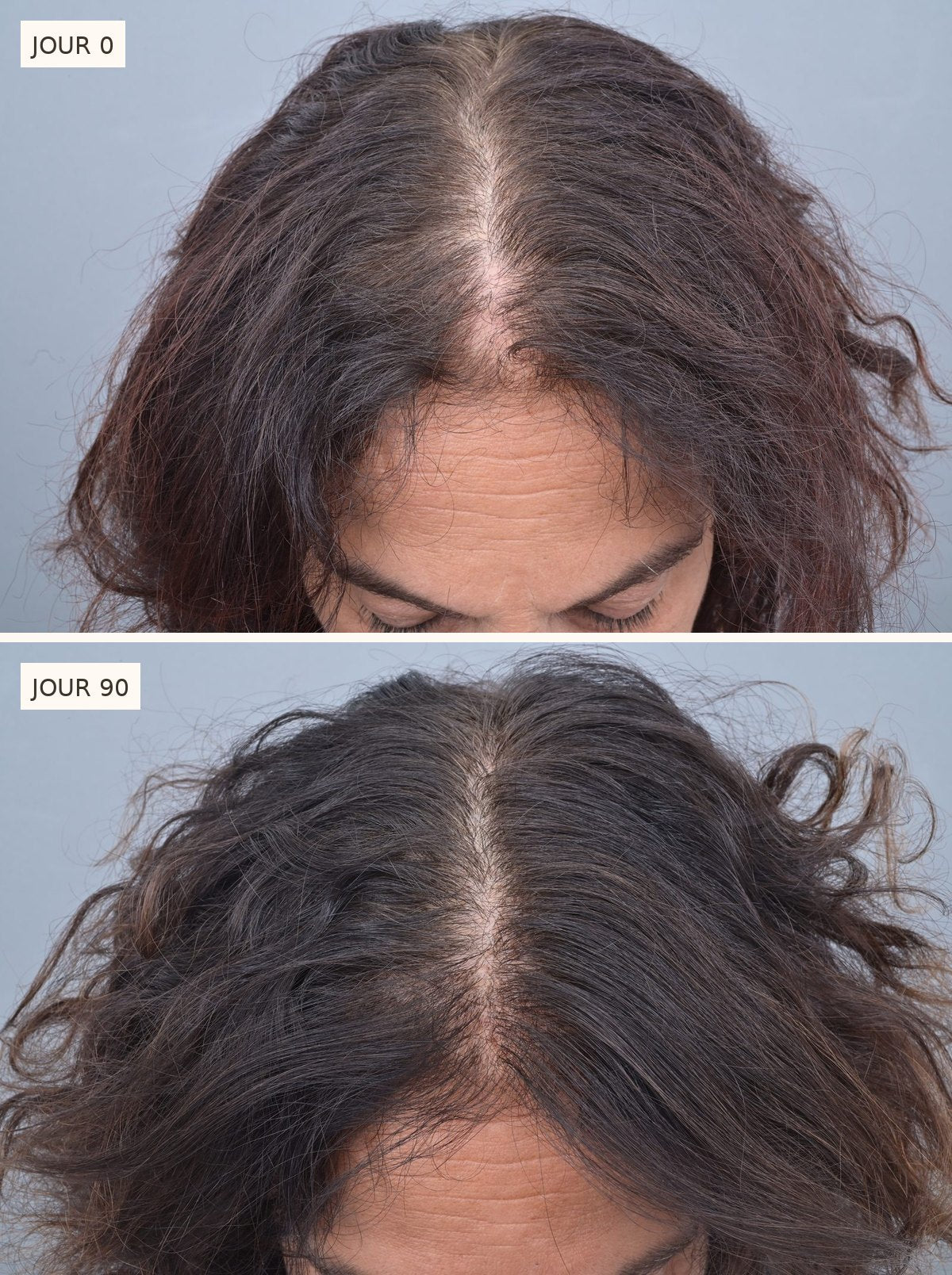 Comparatif du cuir chevelu d'une même femme, vu de dessus : au jour 0, la raie est large et clairsemée ; au jour 90, elle est nettement plus dense.